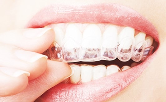 Contention Orthodontique Gouttière