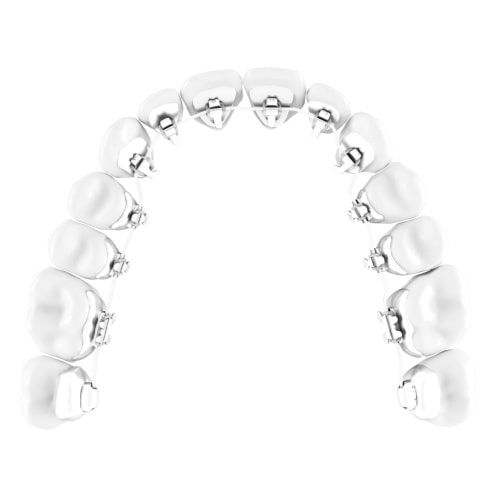Un appareil d'orthodontie linguale